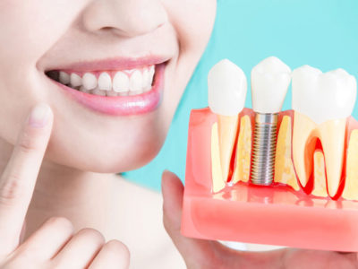 Extracciones dentales modernas